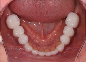 Jaw with Missing Teeth after Dental Implants