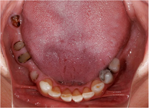 Jaw with Missing Teeth before Dental Implants